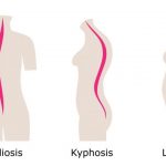 4 Causes Of Loss of Lumbar Lordosis And What Is Lordosis Anyway?
